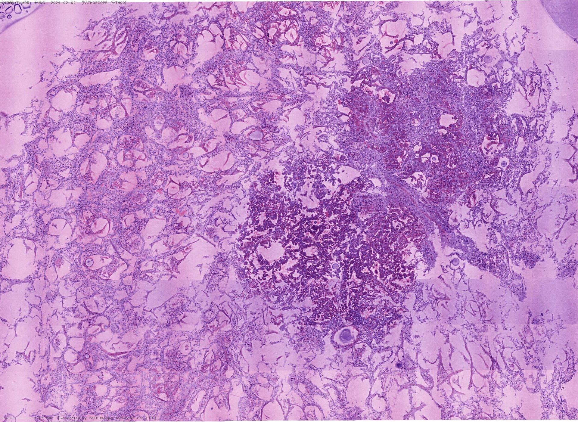 Background Image of Tumor